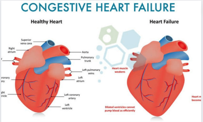 Congestive Heart Failure Symptoms, Causes, and More