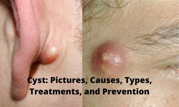 Cyst Pictures, Causes, Types, Treatments, and Prevention