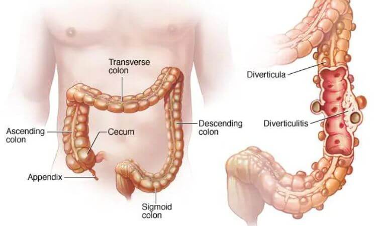 Diverticulitis Symptoms, Causes, Diagnosis & Treatment