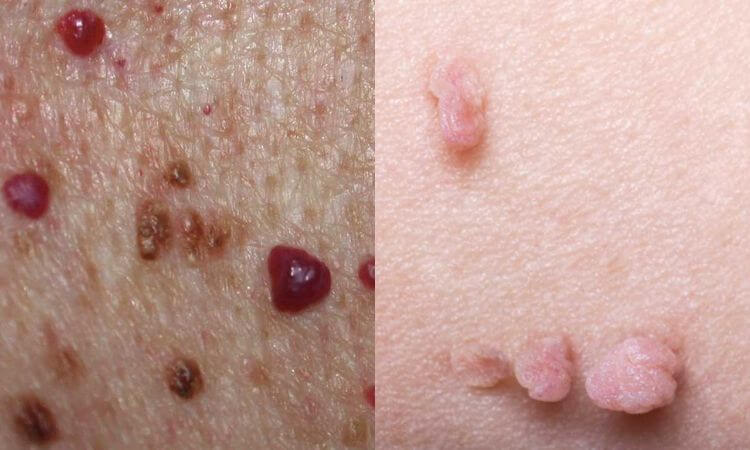 Raised Skin Bumps Types, Causes, and Treatment