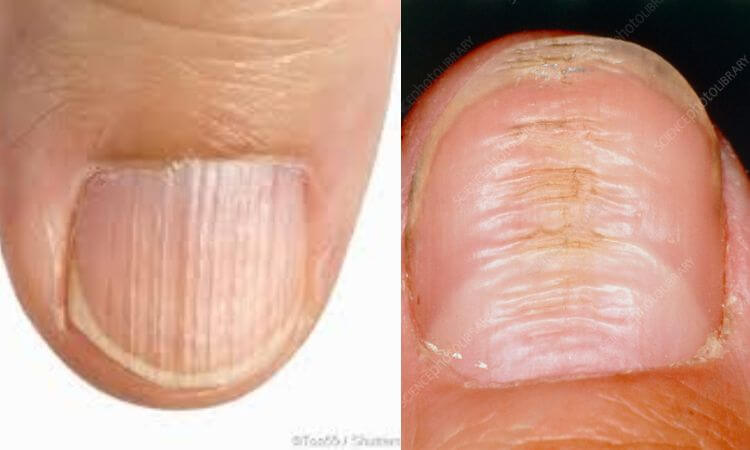 Ridges in Fingernails Symptoms, Causes, and Treatments
