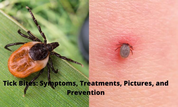 Tick Bites Symptoms, Treatments, Pictures, and Prevention