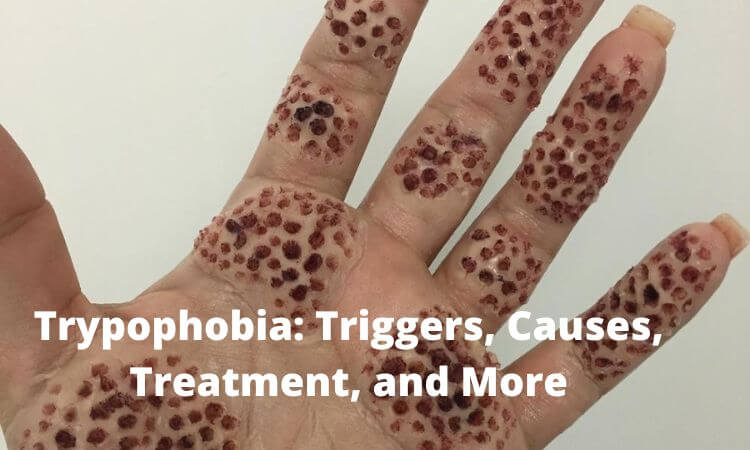 Trypophobia Triggers, Causes, Treatment, and More