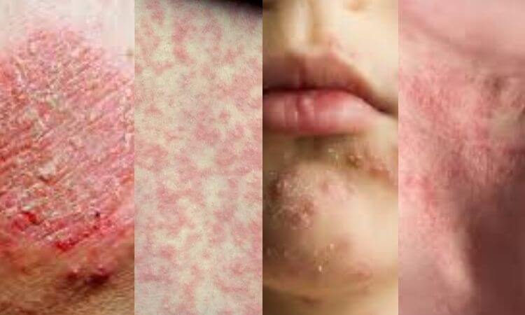 Skin Rashes Causes & Treatment Everything You Need to Know About Rashes