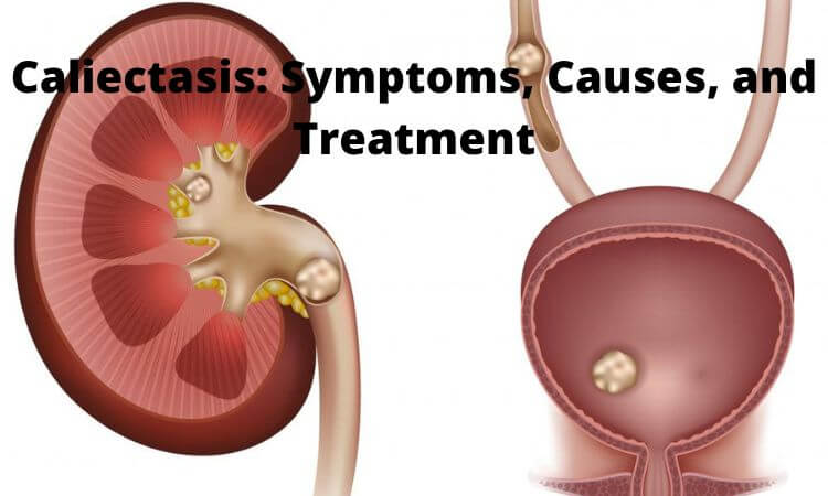 Caliectasis Symptoms, Causes, and Treatment