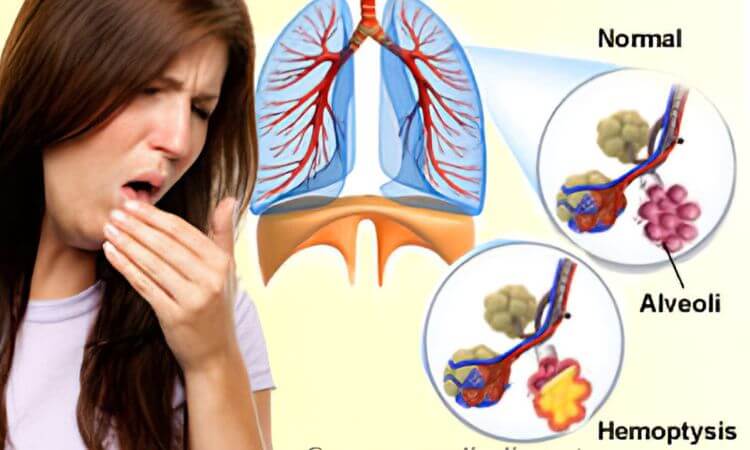 Hemoptysis (Coughing Up Blood) Causes, Treatment & more
