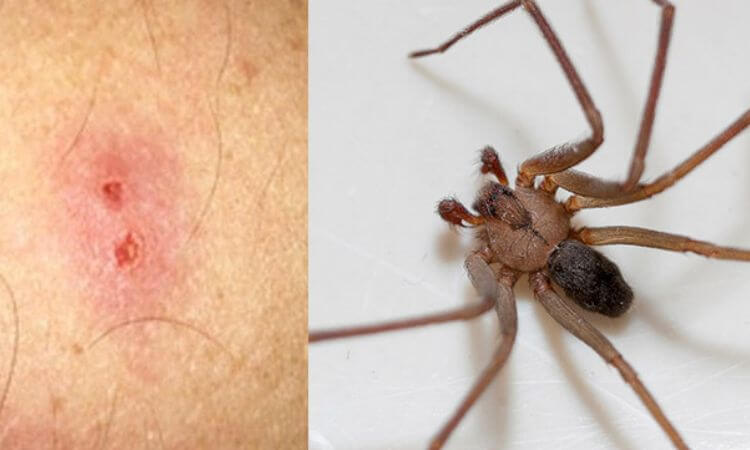 How to Identify and Treat Spider Bites